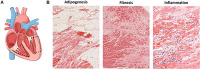 Histopathological Features and Protein Markers of Arrhythmogenic Cardiomyopathy